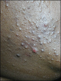 acné microkystes