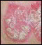 psoriasis