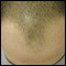alopecie
