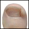 ongle incarne