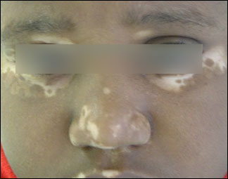 vitiligo-peau-noire